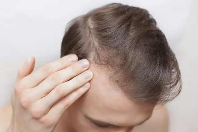  iron deficiency