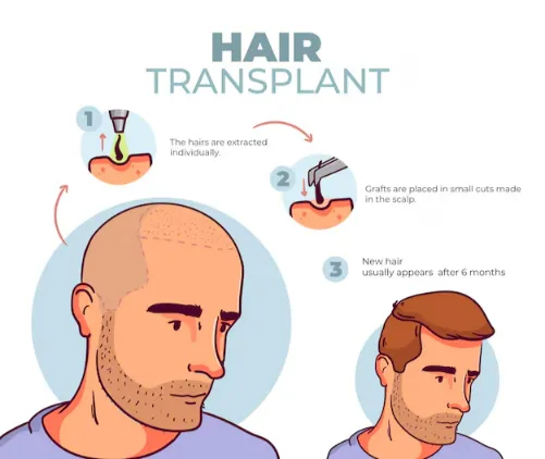 Hair Transplant