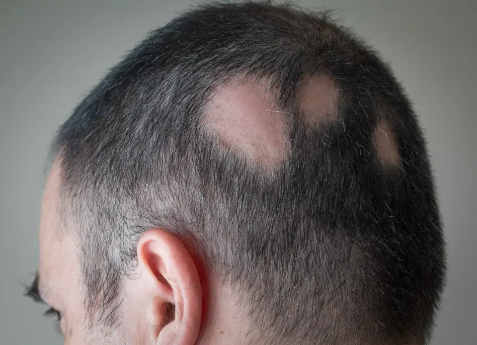 signs of balding