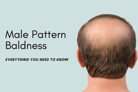 signs of balding